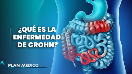 Enfermedad De Crohn | Plan Médico (1/2)