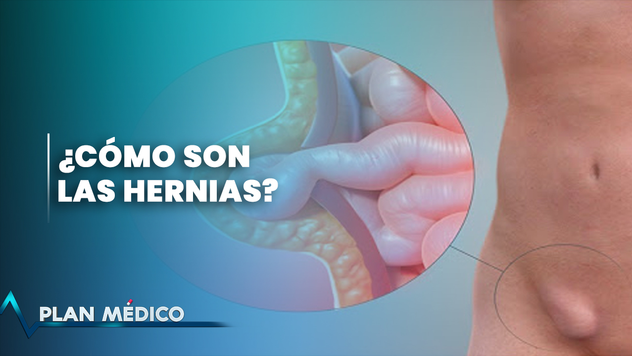 ¿Sabes qué es una hernia? Plan Médico (1/2)